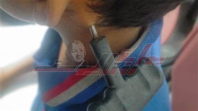 أمهر جراحي مستشفى جامعة الفيوم ينقذون حياة طفل اخترق مفك رقبته 