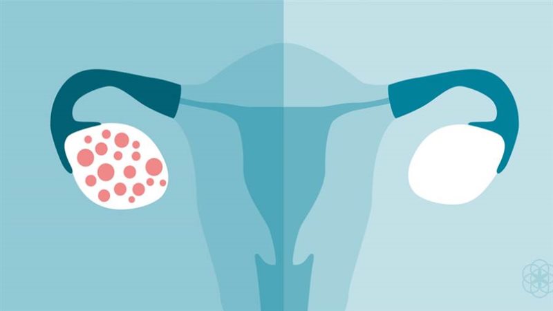تكيس المبيض