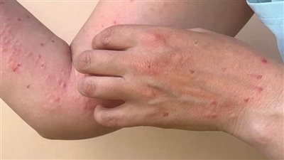 المركز الإفريقي للسيطرة على الأمراض: تسجيل 866 حالة وفاة بـ 