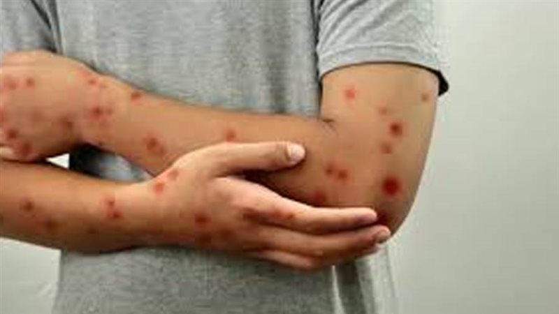 فيروس جدري القرود