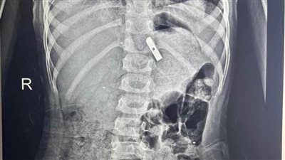 الأطفال التخصصى ببنها ينجح في إنقاذ حياة طفلة ابتلعت براية