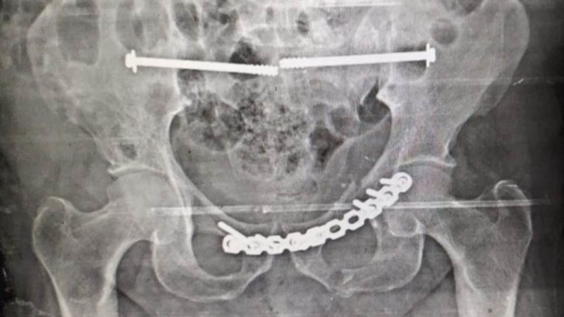 أشعة لإجراء العملية