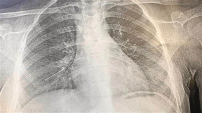 إنقاذ حياة 3 أشخاص بجراحات عاجلة ببنها الجامعي