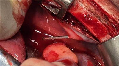 فريق طبي بمستشفى سوهاج الجامعي ينجح في استخراج مسمار معدني اخترق قلب طفل يبلغ من العمر ٨ سنوات