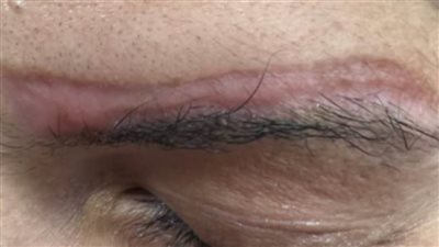  استشاري جلدية تحذر من عمليات التشويه في مراكز التجميل