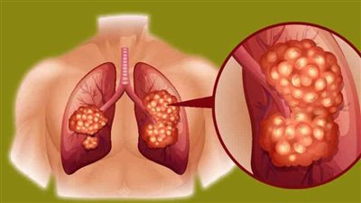 عاجل| علاج جديد يستهدف ورم 