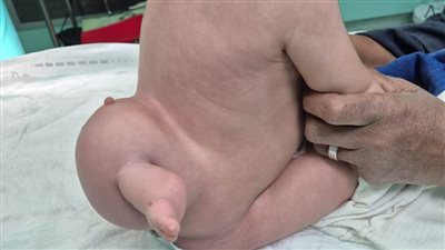 نجاح عملية فصل توأم طفيلي لطفلة أربعة شهور 