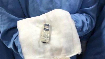 عاجل.. جامعة المنصورة: استخراج هاتف محمول من معدة مريض بالمنظار