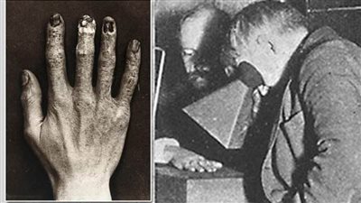 تجربة مأساوية.. كيف أدت الأشعة السينية إلى وفاة مساعد إديسون 