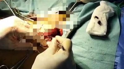 إجراء عملية جراحية خطرة لتسليك شرايين بقسطرة شريانية  