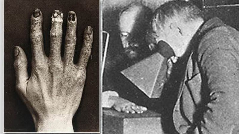 يد دالي تحت الأشعة