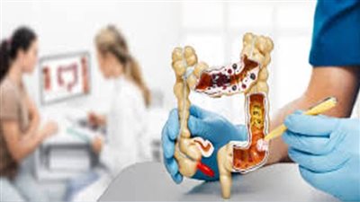 كيف يتم علاج سرطان القولون؟...