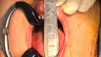 إنجاز طبي جديد.. استخراج قلم رصاص من تحت عين طفل وإصلاح فكّه السفل