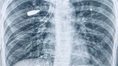 فريق طبي بمستشفى القلب بأسيوط يجري جراحة نوعية لاستخراج مقذوف ناري من رئة فتاة بالمنظار
