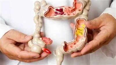 باحثة بقومي البحوث: التغذية والرياضة تخففان أعراض القولون العصبي لدى الطلاب خلال الامتحانات