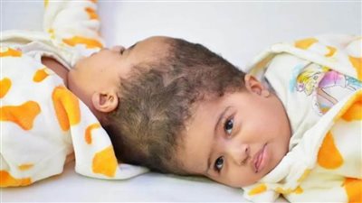 نجاح فصل التوأم الملتصق الإريتري 