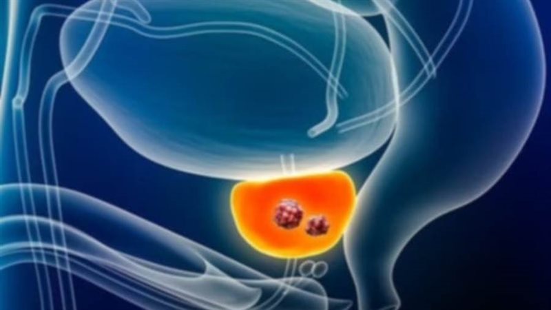 سرطان البروستاتا