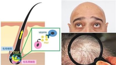 عاجل.. علماء يكتشفون طريقة بسيطة لعلاج تساقط الشعر