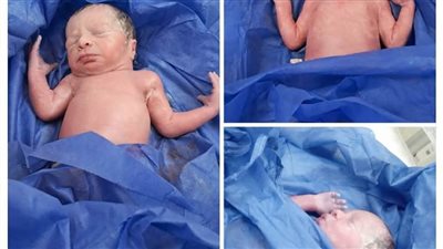 ولادة نادرة لثلاثة توائم بمستشفى العدوة المركزي بالمنيا.. صور