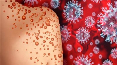 دراسة بلجيكية - كونغولية تكشف أن المتحور الجديد لفيروس جدري القردة ينتقل أثناء الحمل