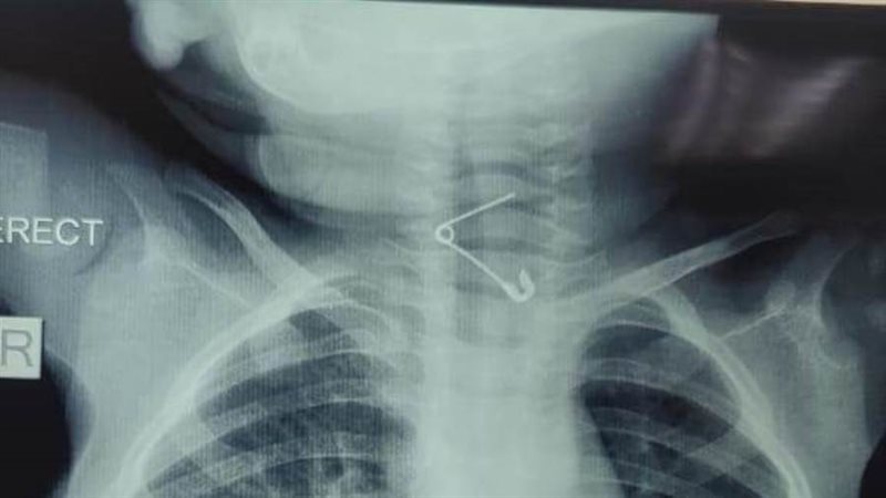 الدبوس يظهر فى حلق