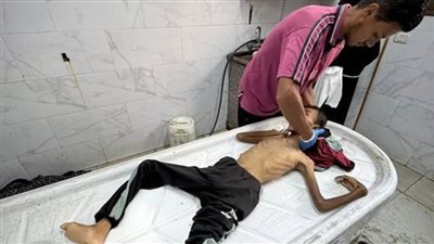 استشهاد 10 فلسطينيين بسبب المجاعة وسوء التغذية في غزة خلال 24 ساعة