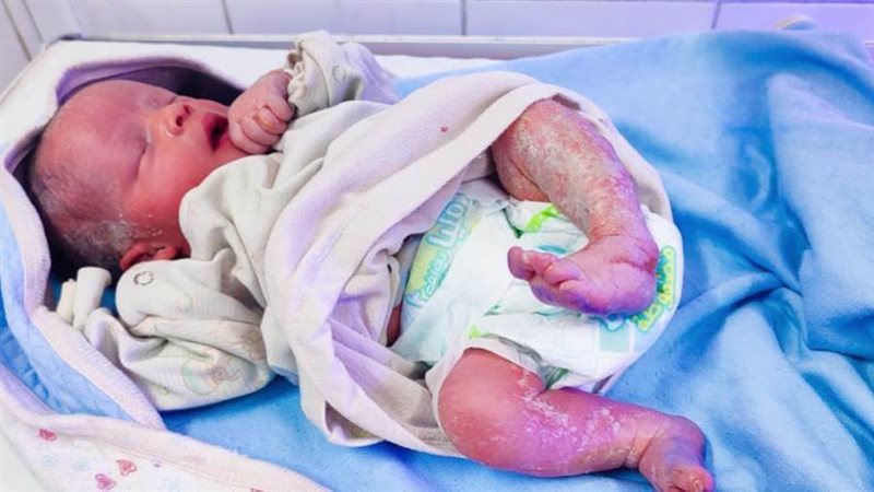 ولادة أول طفل شمعى