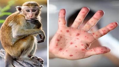 كندا: السلطات الصحية في مونتريال تحذر من عودة تفشي فيروس جدري القرود