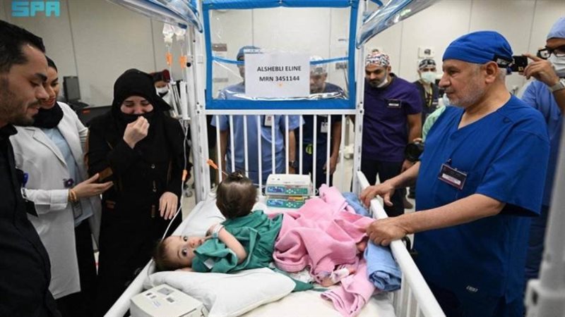 بدء عملية فصل توأم