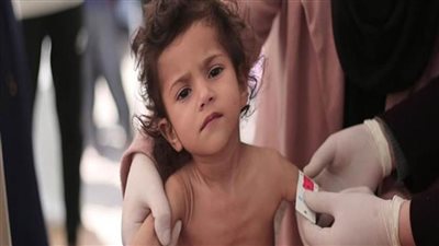 الأمم المتحدة: سوء التغذية الحاد بين الأطفال بغزة وصل أعلى مستوى