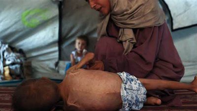  الصحة العالمية: وفاة 99 شخصًا بسبب سوء التغذية والجوع في غزة