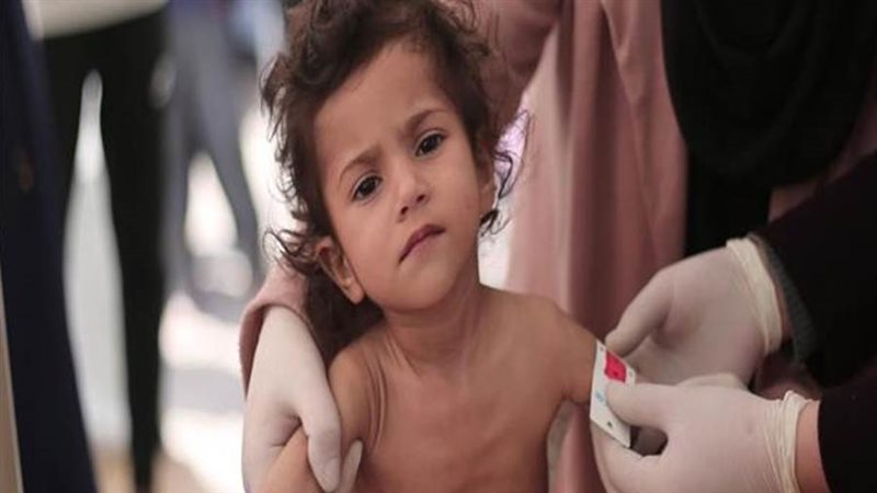 سوء التغذية