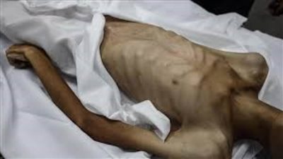 وفاة 7 فلسطينيين نتيجة التجويع وسوء التغذية في غزة