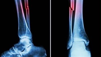 غراء العظام.. اختراع صيني يعالج الكسور في ثلاث دقائق