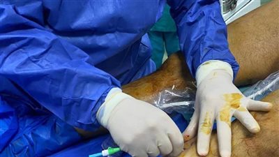 بالصور.. إجراء أول جراحة باستخدام التردد الحراري لعلاج دوالي ساق في 