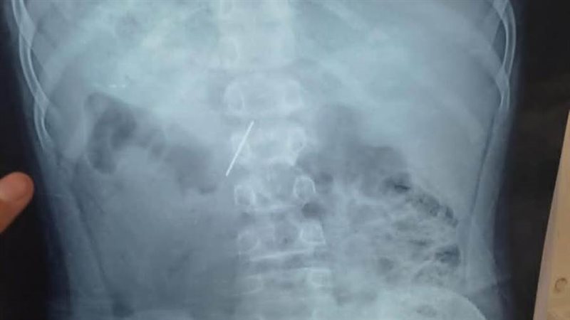 أشعة توضع موقع الدبوس