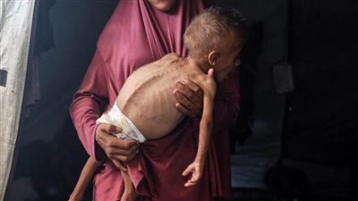 ارتفاع إجمالي وفيات سوء التغذية بغزة إلى 457