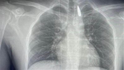 أطباء جامعة الإسكندرية ينقذون مريضًا فلسطينيًا ويستخرجون رصاصة استقرت بجانب الشريان الأورطي