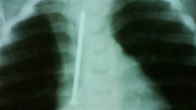 إنقاذ حياة طفلة ابتلعت مسمار 6 سم بمستشفى الأطفال التخصصى ببنها 