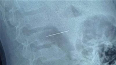 إنقاذ حياة طفل ابتلع مسمار دباسة بمستشفى الأطفال التخصصي في بنها