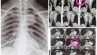 مستشفيات جامعة أسيوط تعلن نجاح فريق طبي بإنقاذ حياة أم وجنينها