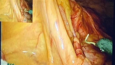 مستشفى سوهاج الجامعي تنجح في استئصال ورم بالقولون طوله ١٠ سم لمريض عمره ٦٥ عامًا