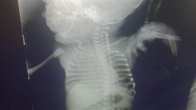 إنقاذ حياة جنين وأمه المصابة بطلق ناري بمستشفى أبوحماد المركزي بالشرقية 