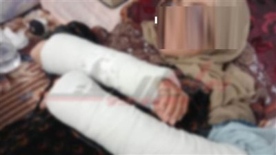 أصابها بكدمات واشتباه كسر.. شاب يتعدى على زوجة عمه بالشرقية