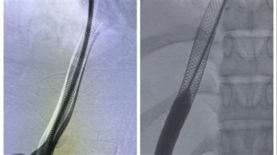 فريق طبي بأسيوط ينقذ حياة فتاة تعاني من فشل كبدي باستخدام الأشعة التدخلية 