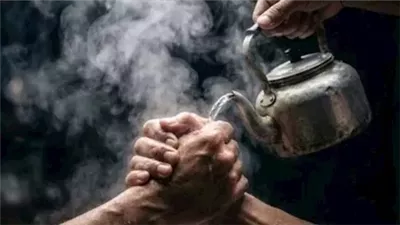 نقابة الأطباء تحذر من دعوات تشجع على سكب المياه الساخنة أو المغلية على اليدين