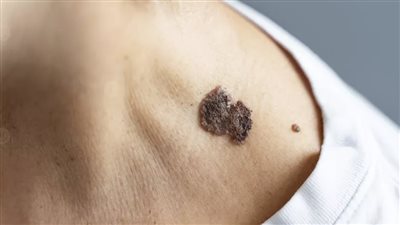 روسيا تبدأ استخدام دواء لعلاج سرطان الجلد 