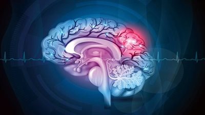 غدا.. انطلاق المؤتمر الدولي الثالث للسكتة الدماغية والقسطرة المخية بالقاهرة