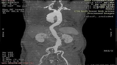 إجراء عملية تمدد بالشريان الأورطي دون جراحة بالتأمين الصحي بالقليوبية