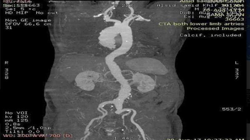 إجراء عملية تمدد